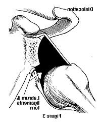 Diagram showing a torn shoulder ligament and labrum