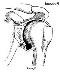 Diagram showing a reduced shoulder, where the humeral head is back in place